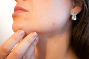 Consejos y verdades sobre el acné y cómo tratarlo