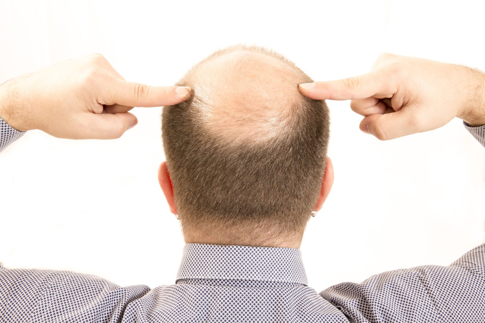 What Counts As Excessive Hair Loss