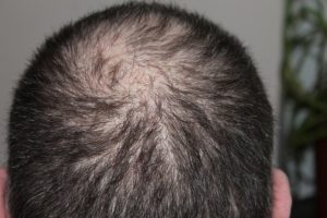 Causas De La Pérdida Excesiva de Cabello