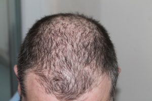 Tratamientos y  productos naturales para prevenir la alopecia y reducir su evolución