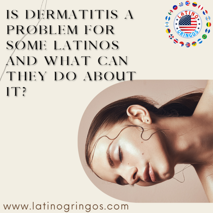 Is Dermatitis a Problem for Some Latinos and What Can They do About it?