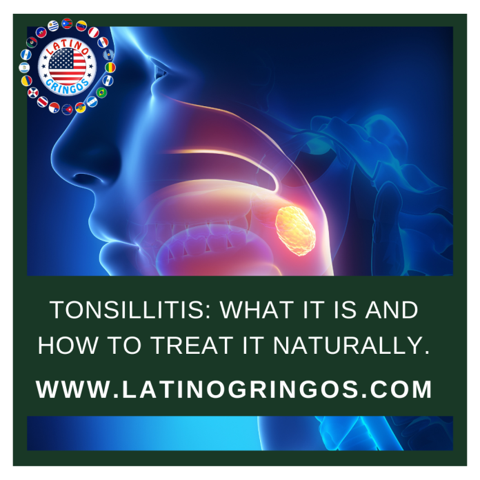 Tonsillitis what it is and how to treat it naturally.